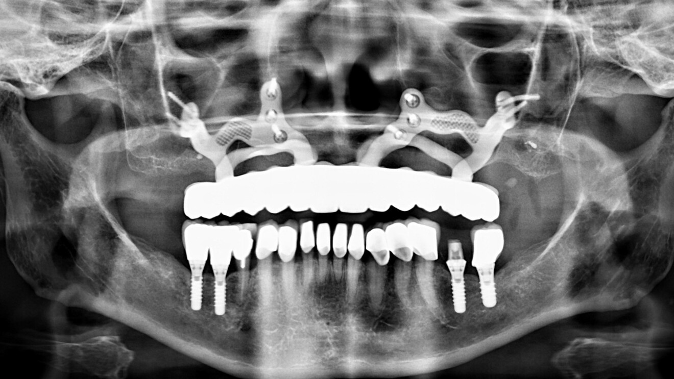 Fig. 2b : Courtoisie du Dr P Mestrallet. Orthopantomogramme postopératoire.