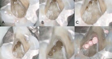 Scouting the root canal with dedicated NiTi files