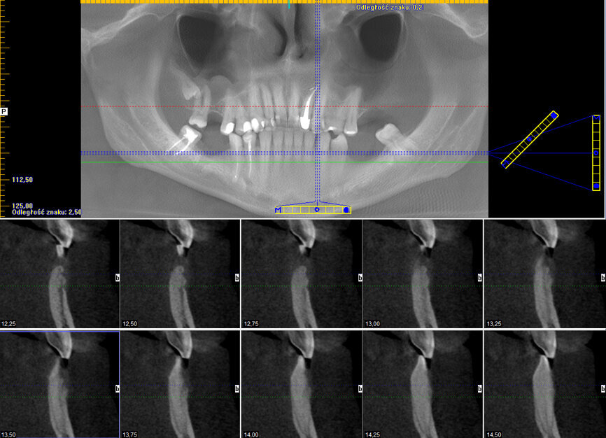 Ryc. 4: CBCT wykonane 18 miesięcy po zabiegu.