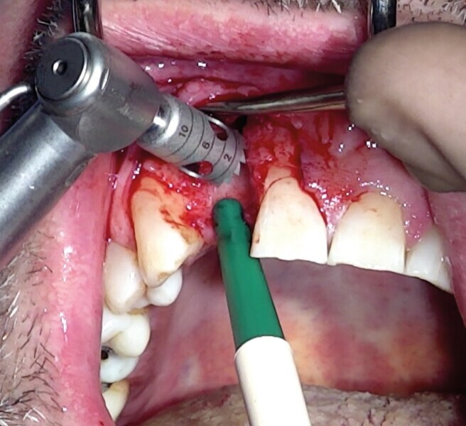 Fig. 14 : Calibrage circulaire par un trépan. 