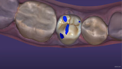 exocad – DentalCAD 3.2. Elefsina Highlights