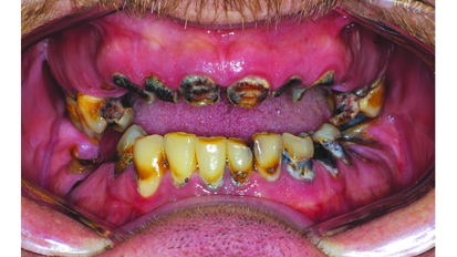 Complete reconstruction for a patient with chronic tooth decay