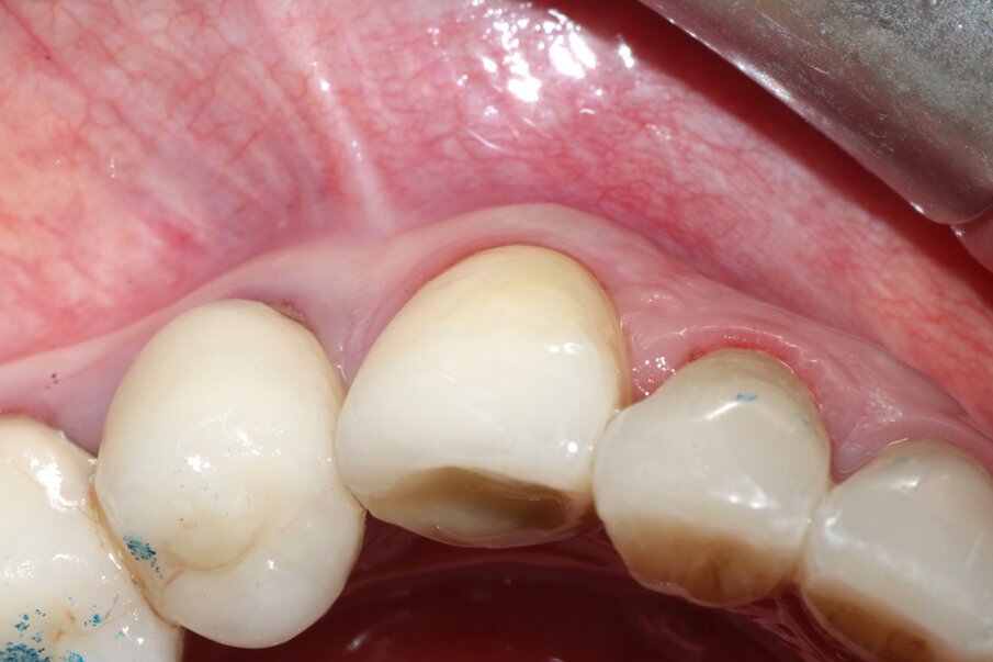 Figg. 16, 17_Visione occlusale dei tessuti guariti e alla consegna della corona; si noti il mantenimento della bozza canina.
