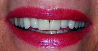 ΕΞΑΓΩΓΗ, ΑΜΕΣΗ ΤΟΠΟΘΕΤΗΣΗ ΕΜΦΥΤΕΥΜΑΤΟΣ ΚΑΙ ΑΜΕΣΗ ΤΟΠΟΘΕΤΗΣΗ ΜΗ ΛΕΙΤΟΥΡΓΙΚΗΣ ΠΡΟΣΩΡΙΝΗΣ ΑΠΟΚΑΤΑΣΤΑΣΗΣ ΑΚΟΛΟΥΘΩΝΤΑΣ ΜΙΑ ΠΛΗΡΩΣ ΨΗΦΙΑΚΗ ΡΟΗ ΕΡΓΑΣΙΩΝ ΕΞΑΓΩΓΗ, ΑΜΕΣΗ ΤΟΠΟΘΕΤΗΣΗ ΕΜΦΥΤΕΥΜΑΤΟΣ ΚΑΙ ΑΜΕΣΗ ΤΟΠΟΘΕΤΗΣΗ ΜΗ ΛΕΙΤΟΥΡΓΙΚΗΣ ΠΡΟΣΩΡΙΝΗΣ ΑΠΟΚΑΤΑΣΤΑΣΗΣ ΑΚΟΛΟΥΘΩΝΤΑΣ ΜΙΑ ΠΛΗΡΩΣ ΨΗΦΙΑΚΗ ΡΟΗ ΕΡΓΑΣΙΩΝ