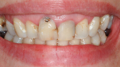 Approccio interdisciplinare paro-protesico di una riabilitazione in area estetica