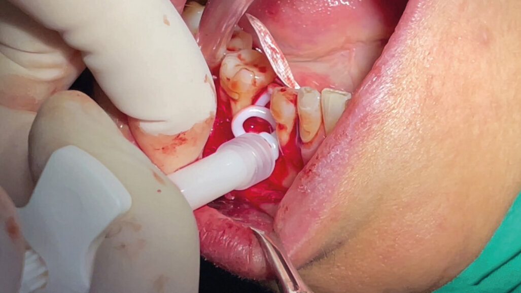 Rigenerazione ossea tramite membrana non riassorbibile e materiale alloplastico nella perdita di volume parodontale post-estrattiva