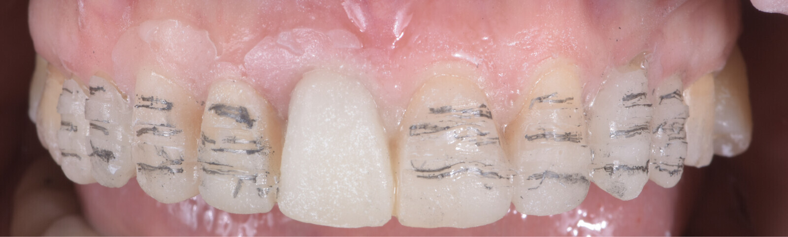 Fig. 16: Tooth preparation through the mock-up.