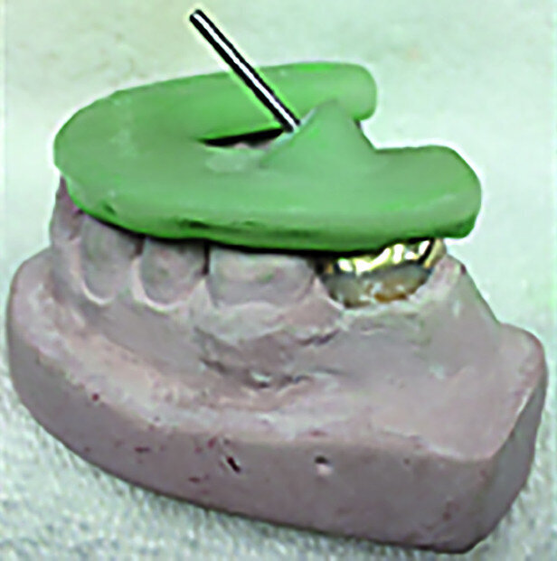 Figs. 12a–d : Depuis la gauche : Cas de l’auteur : dent
37 présentant une fracture radiculaire ; cette dent
montée dans un modèle en plâtre-pierre après extraction,
avec impression du guide de forage CTGEA
monté et du premier foret en place ; les deux
petits orifices d’accès préparés au moyen du guide
de forage ; et la radiographie postopératoire montrant
l’adaptation des cônes dans les canaux après leur négociation et leur mise en forme.