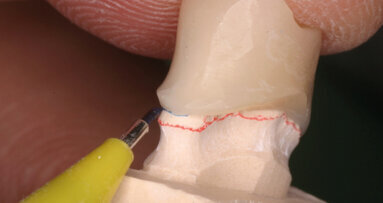 La validazione clinica dei prototipi in protesi fissa in ambiente digitale CAD/CAM