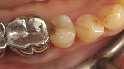 Class II restoration with thermo-viscous composite