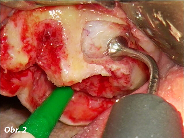 Po zvednutí kostního krytu se šetrně odstraní zbývající kost. Při použití nástroje podobného slonímu chodidlu (S3) chrání Schneiderianskou membránu tenká vrstva chladicího média vytékajícího ze tří trysek.