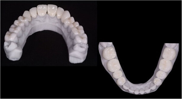 Fig. 12. Carillas y coronas finales preparadas digitalmente con el software de diseño Ceramill Mind y producidas en una fresadora (Ceramill Motion 2) a partir de bloques de cerámica de disilicato de litio mecanizables (VITABLOCS TriLuxe forte).