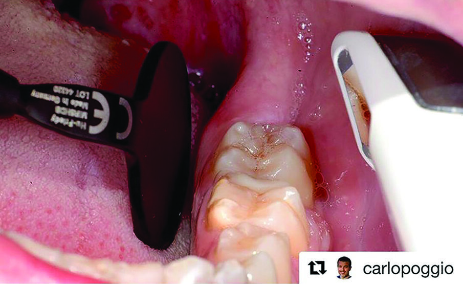 By using Hu-Friedy’s new HD Black Line Mirror I definitely solved the light reflection issues.