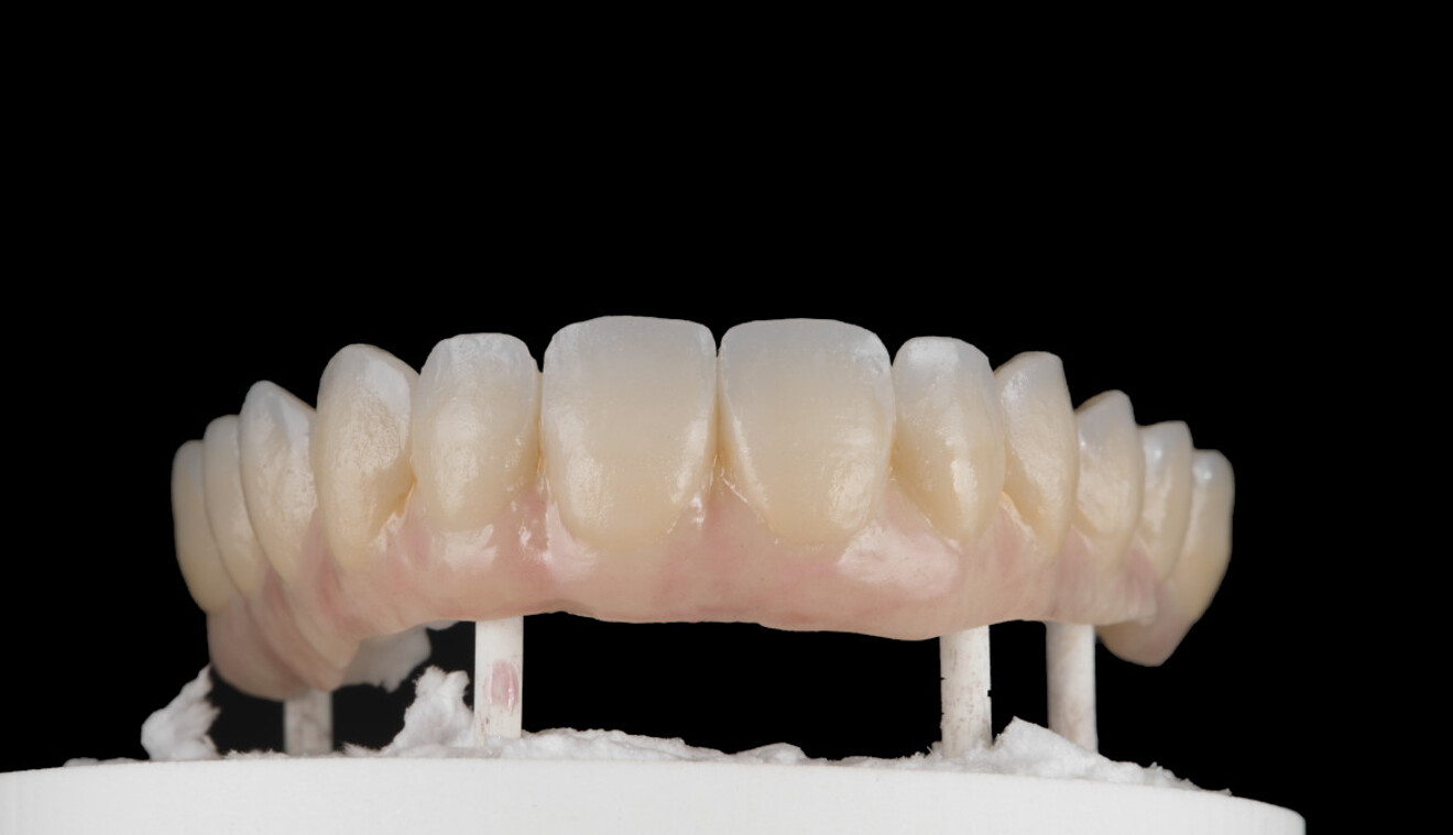Fig. 9a: Application of GC Initial IQ Lustre Pastes ONE, GC Initial Spectrum Stains and GC Initial IQ Lustre Pastes NF Gum Shades during internal characterisation at an earlier stage.