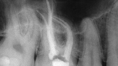 The real state of endodontic instrumentation The real state of endodontic instrumentation