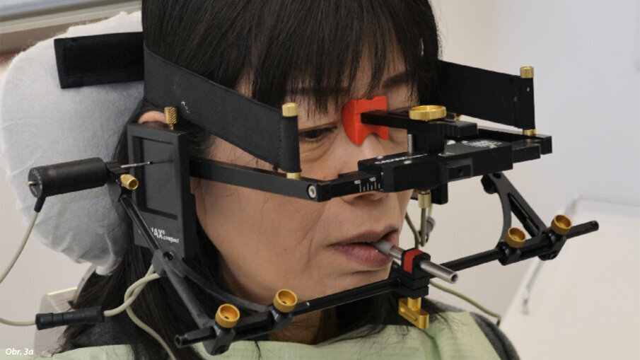 Pomocí obličejového oblouku bylo získáno značné množství dat, která byla přenesena do artikulátoru Artex CR.