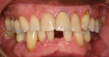 The compromised implant site solution