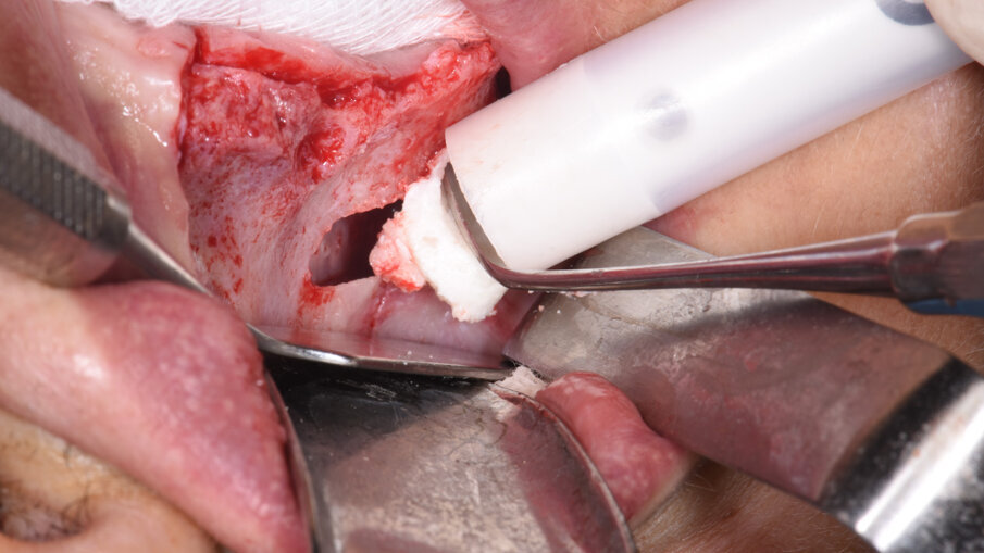 Obr. 5a, b: Umístění kolagenního náhradního kostního materiálu sticky bone do antrostomie na pravé straně (a)