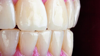 Résine composite injectable : une nouvelle technique – Part I