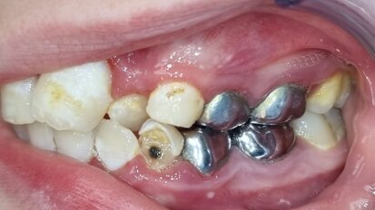 Wie moet het cariësprobleem oplossen?