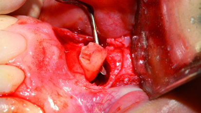 Supernumerary teeth: Diagnosis and treatment