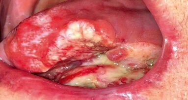 El dentista en el tratamiento del cáncer de cabeza y cuello