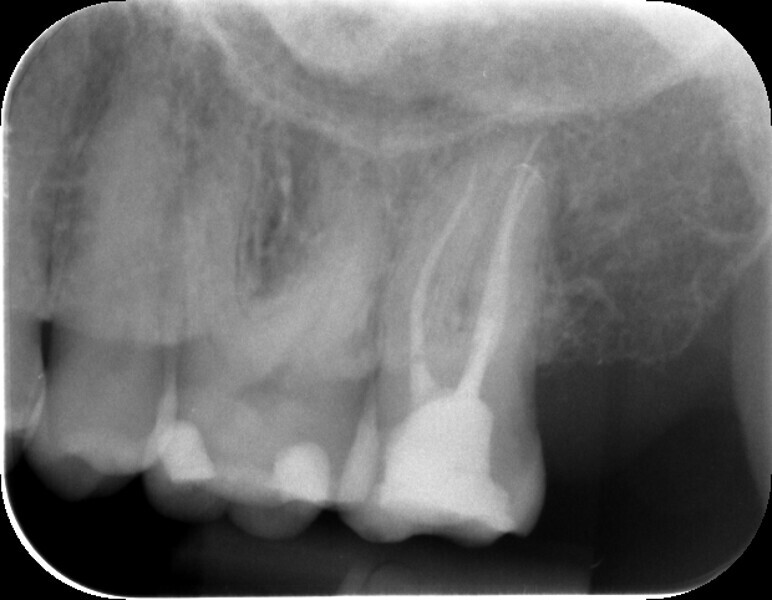 Fig. 7: Post-op radiograph of tooth #27.