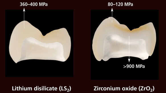 Study: IPS e.max lithium disilicate material the most durable ceramic tested to date