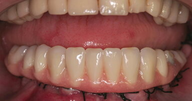 The ‘All-on-4’ implant concept for edentulous jaws