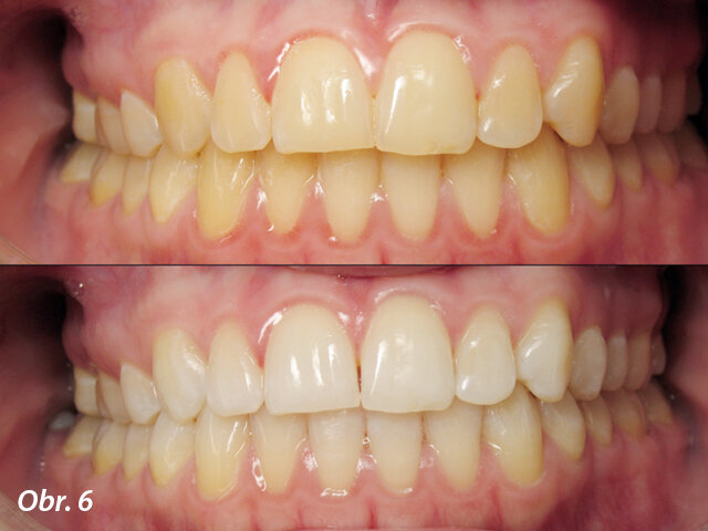Obr. 7: Klinický případ před a po bělení zubů pomocí univerzálních nosičů.