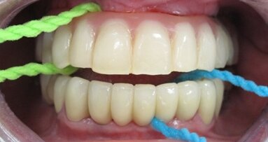 Let’s X-Floss those Implants