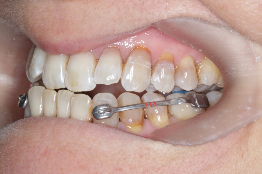 Fig. 29: Placement of the Carriere Motion 3D Class III appliance.
