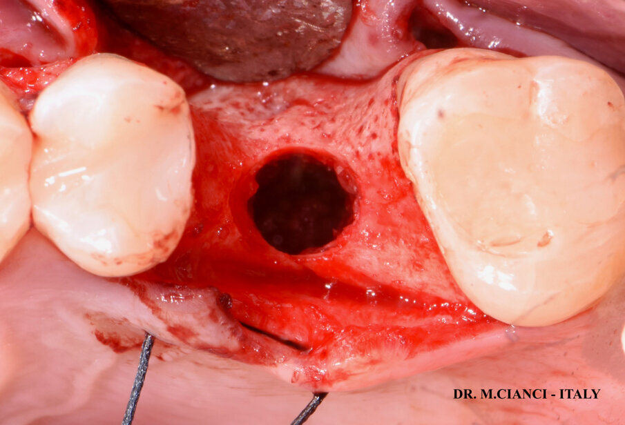 Fig. 6 - Membrana di Schneider.