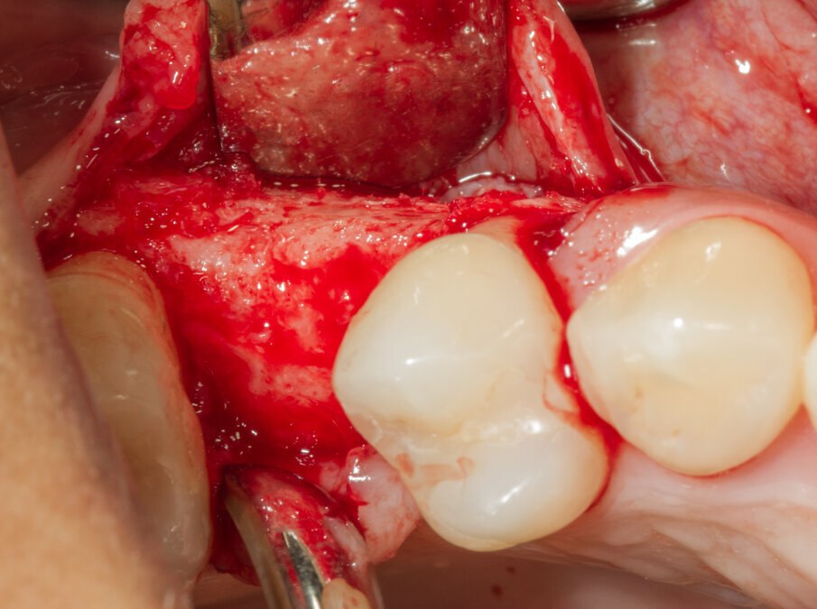 Fig. 18 - Ricostruzione completa del Bone Housing.