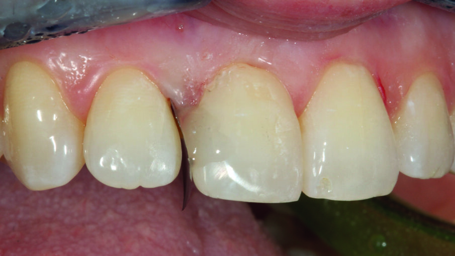 Afbeelding 5. Fosforzuurconditionering van element 12.
