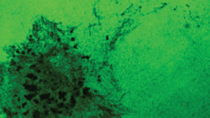 Posible causa de la metástasis en el cáncer oral Posible causa de la metástasis en el cáncer oral
