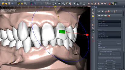 Polorto – DDP-Ortho – Aligner Attachment Design by Clinician