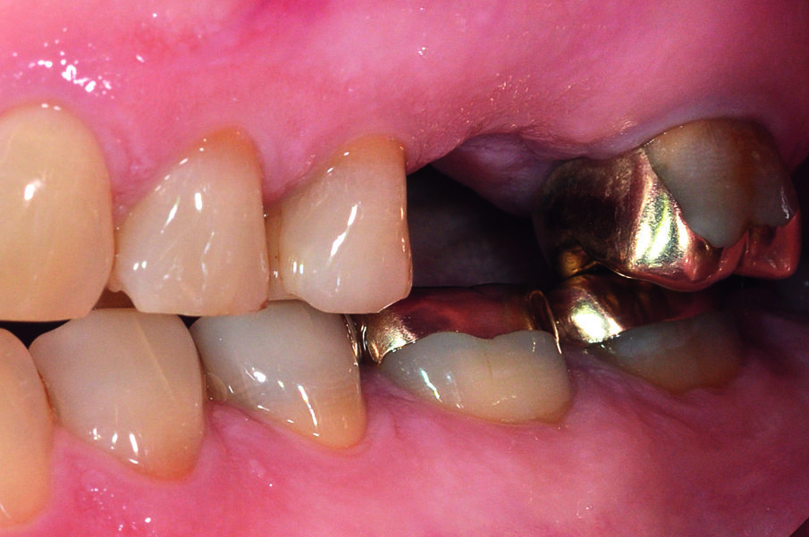 Fig. 2: The vestibular ridge after the bone-sparing extraction.