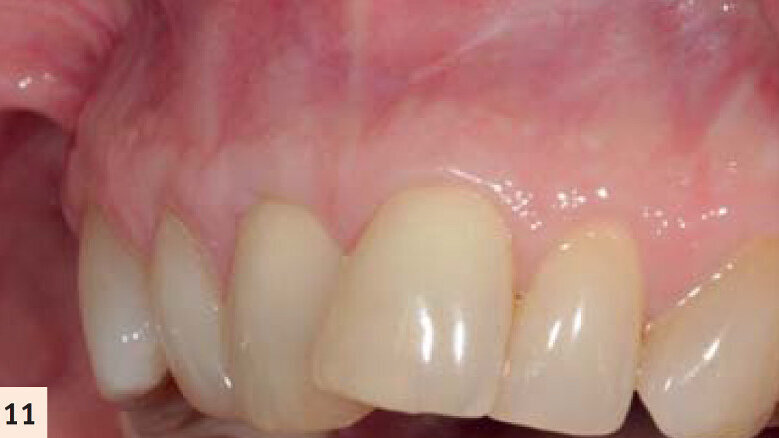 Technique innovante dans le recouvrement des racines dentaires : Le concept FASTP