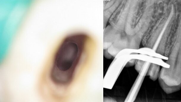 Lấy Dụng Cụ Gãy Trong Ống Tuỷ: 2 Case Lâm Sàng