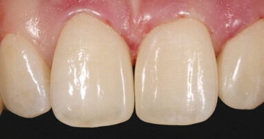 Zatvaranje dijastema kompozitom. Poseban izazov ili standardna situacija?