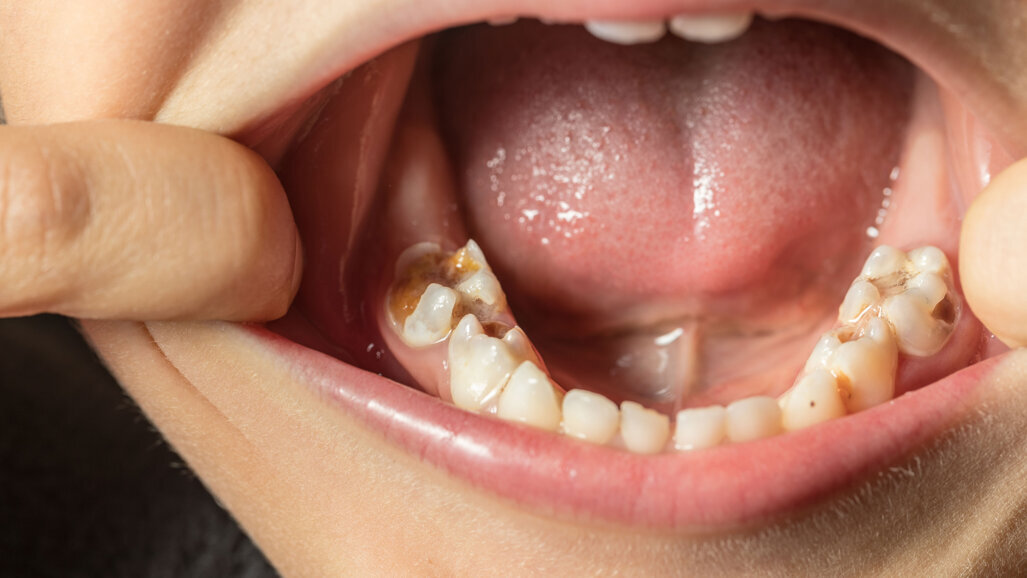 Effektive Kariesprävention in Schulen mit Silberdiaminfluorid