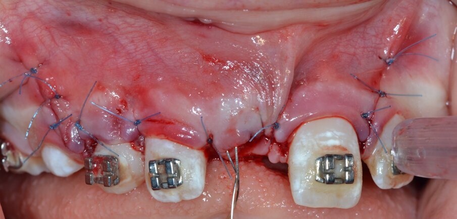 Fig. 18_Riposizionamento del lembo e sutura con filo in Nylon 5/0.