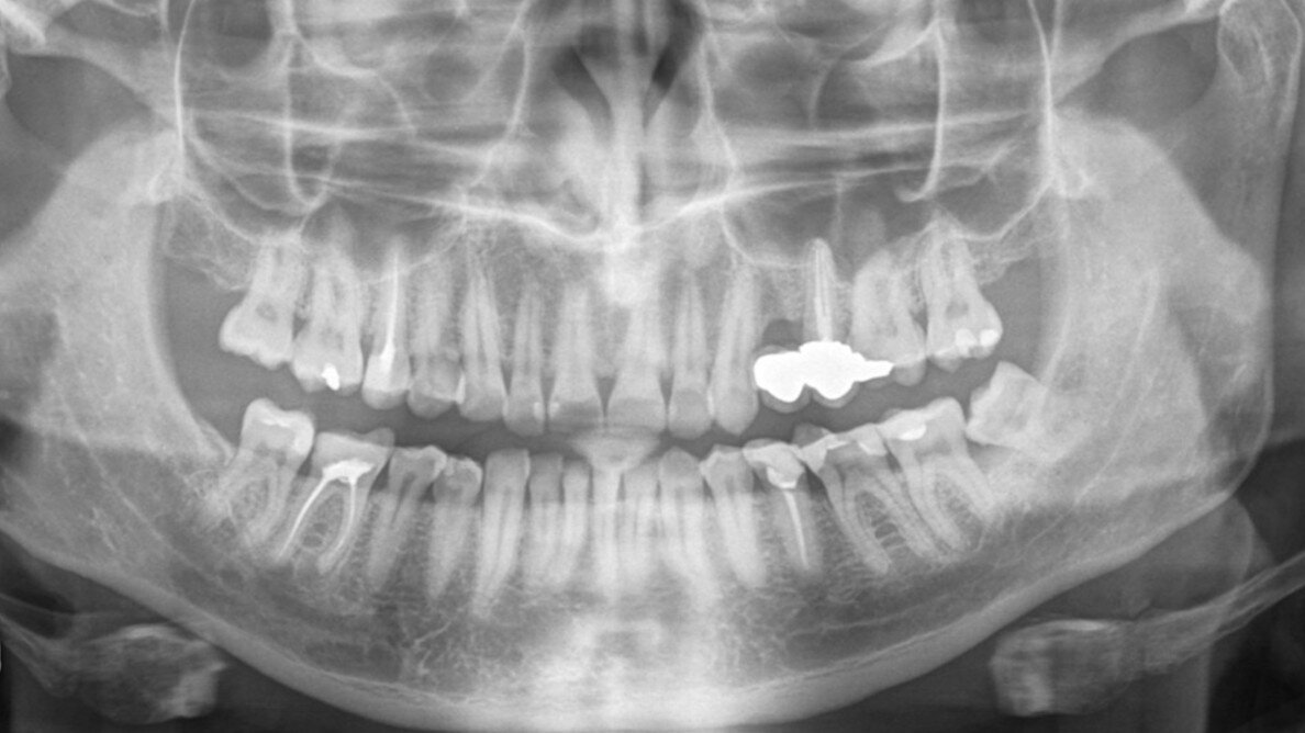 Endodontic treatment of maxillary left first molar with complicated root canal system