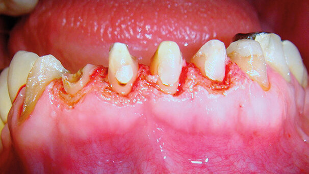 Gengivoplastica con laser a diodo: rapidità, efficacia, mininvasività e predicibilità