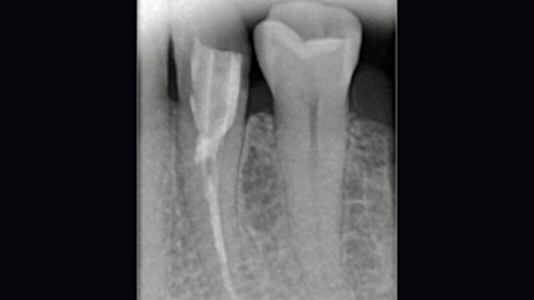Fig. 2. Estado tras la revisión, la colocación de la espiga y la reconstrucción.