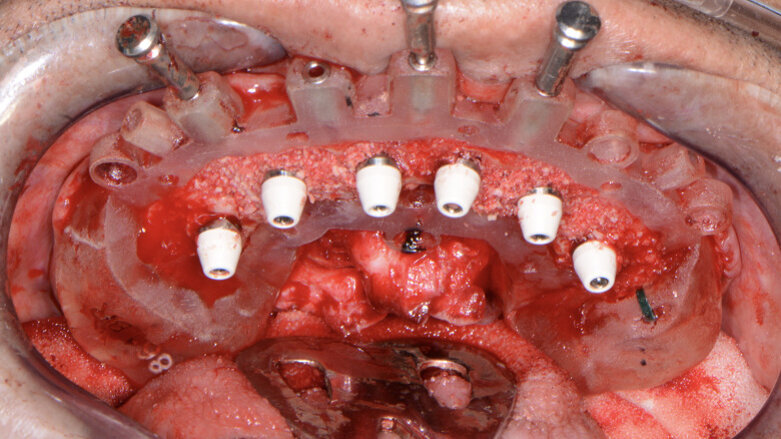 Predictable guided implant placement for full-mouth reconstruction