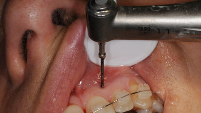 Ostéo-activation : dix-neuf ans de recul