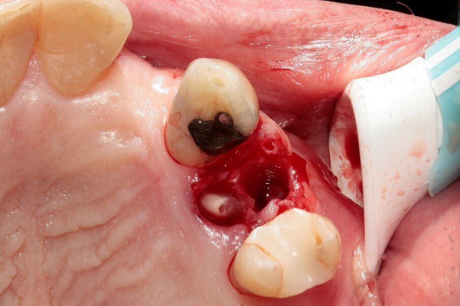 Fig. 9: During luxation, the palatal root was partially fractured while in the alveolus.