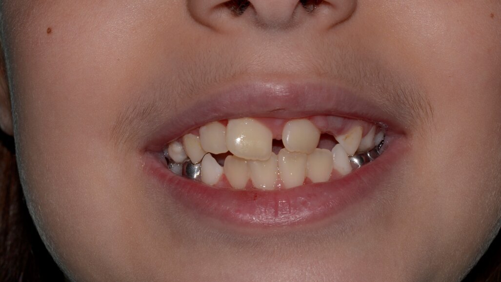 An Unerupted Maxillary Permanent Central Incisor and its Multi-Faceted Management